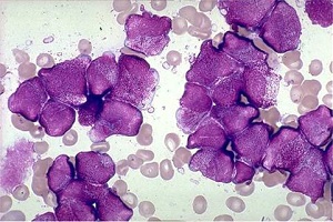 顕微鏡写真：白血病細胞