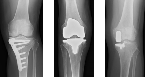 X線写真：膝関節