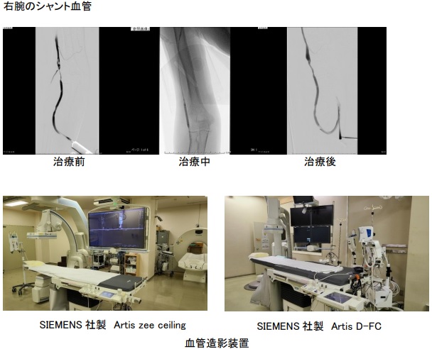 写真：右腕のシャント血管、血管造影装置（SIEMENS社製 Artis zee ceiling、SIEMENS社製 Artis D-FC）