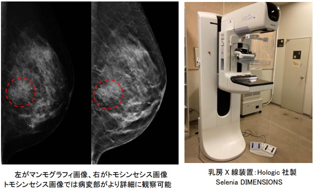 写真:マンモグラフィ画像とトモシンセンス画像の比較、乳房X線装置