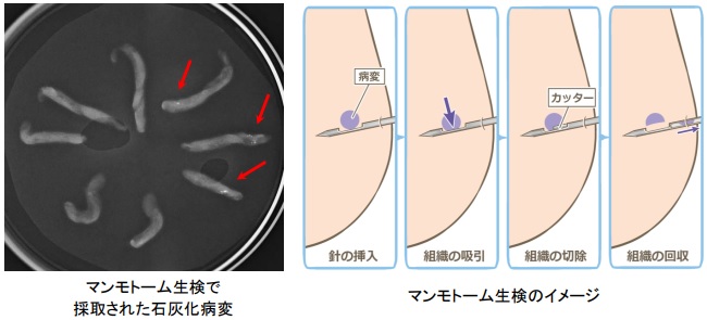 写真：マンモトーム生検で搾取された石灰化病変、イラスト：マンモトーム生検のイメージ
