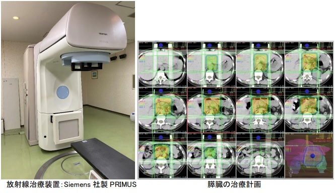 写真:放射線治療装置 Siemens社製PRIMUS、膵臓の治療計画