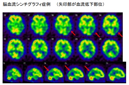 画像:脳血流シンチグラフィ症例