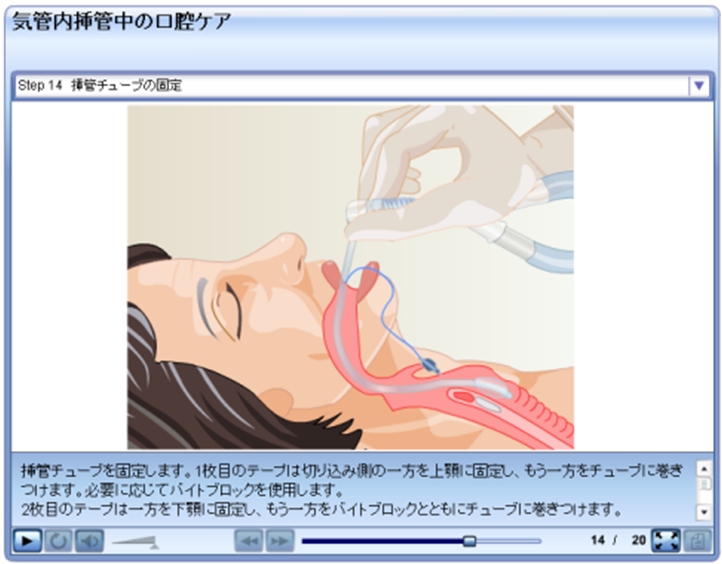 画像：気官内挿管中の口腔ケア